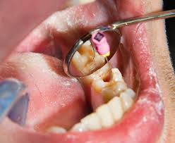 Endodontics Treatment